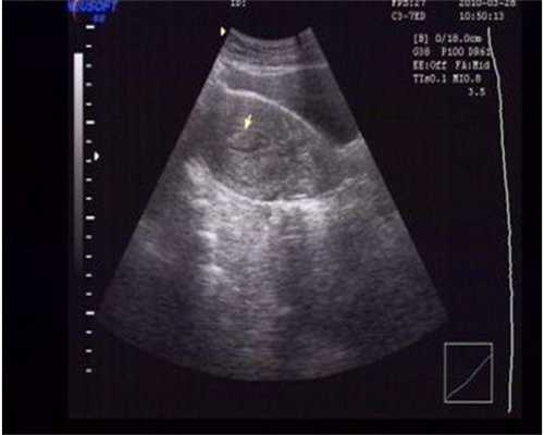 子宫内膜增厚怎么办？怎么防止子宫内膜的增厚、恶变？