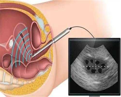 广州代生机构价格，【在广州供卵机构靠谱吗】出现宫腔积液，不要慌（下）