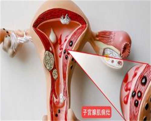 广州中山六院供卵费用大概多少钱