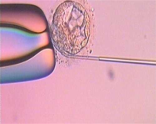 浙江供卵试管生男孩包成功费用明细参考，2026助孕费用明细一览