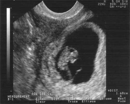 邵阳供卵试管机构：第三代试管婴儿囊胚移植第二天最关键！