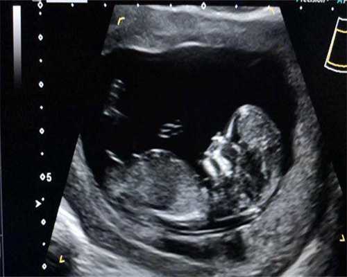 <strong>盆腔炎会不会影响怀孕做试管婴儿能提高怀孕*率</strong>