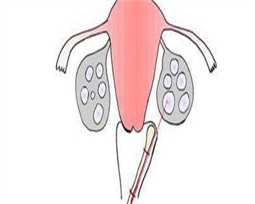 广州中山一院试管供卵,广州中山一院申请供卵做试管要排队等多久