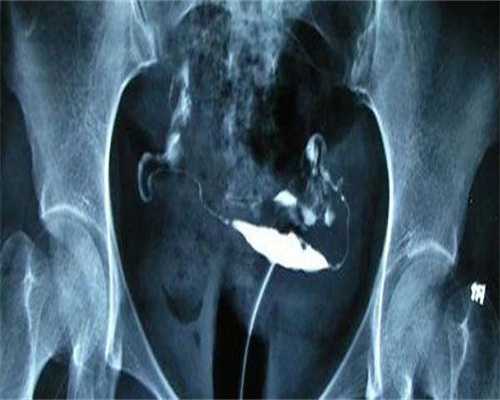 助孕单身女性：试管移植后注射黄体酮的作用你都知道吗？